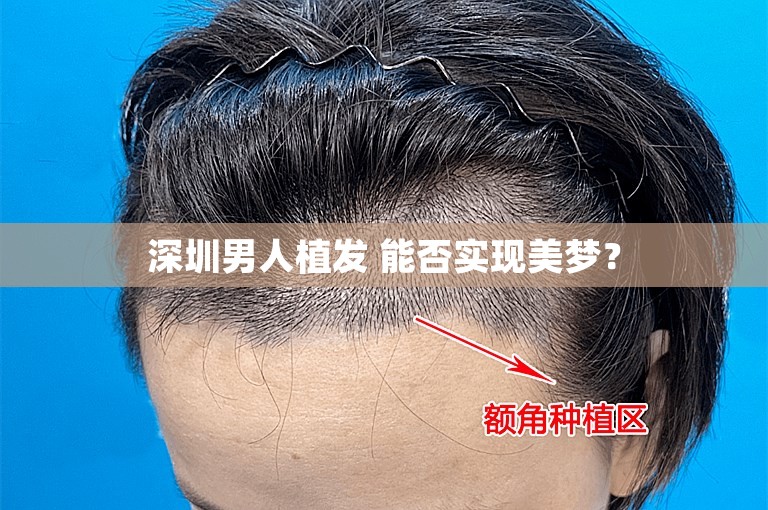 深圳男人植发 能否实现美梦？