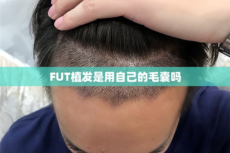 FUT植发是用自己的毛囊吗