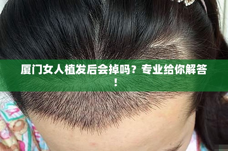 厦门女人植发后会掉吗？专业给你解答！