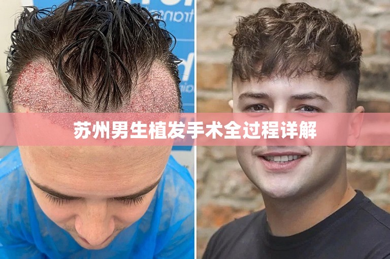 苏州男生植发手术全过程详解