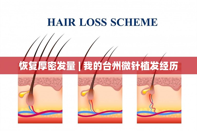 恢复厚密发量 | 我的台州微针植发经历