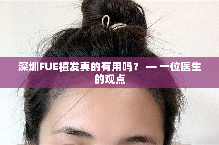 深圳FUE植发真的有用吗？ — 一位医生的观点