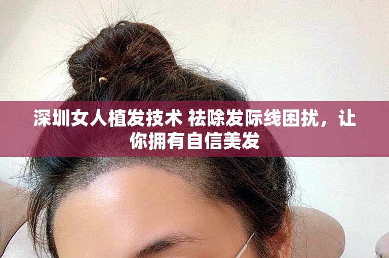 深圳女人植发技术 祛除发际线困扰，让你拥有自信美发