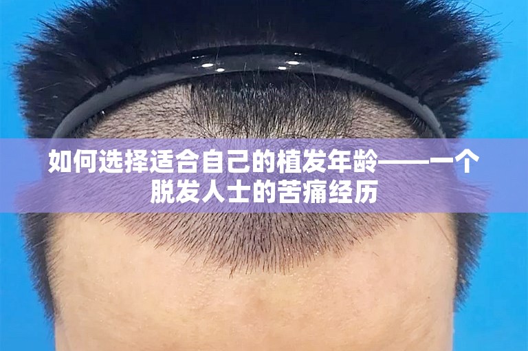 如何选择适合自己的植发年龄——一个脱发人士的苦痛经历