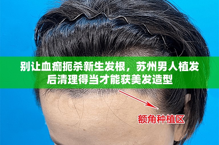 别让血痂扼杀新生发根，苏州男人植发后清理得当才能获美发造型