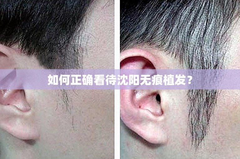 如何正确看待沈阳无痕植发？