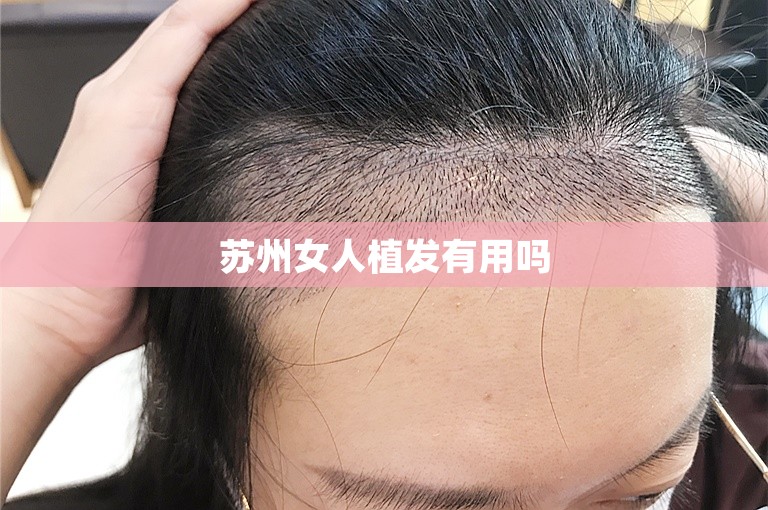 苏州女人植发有用吗