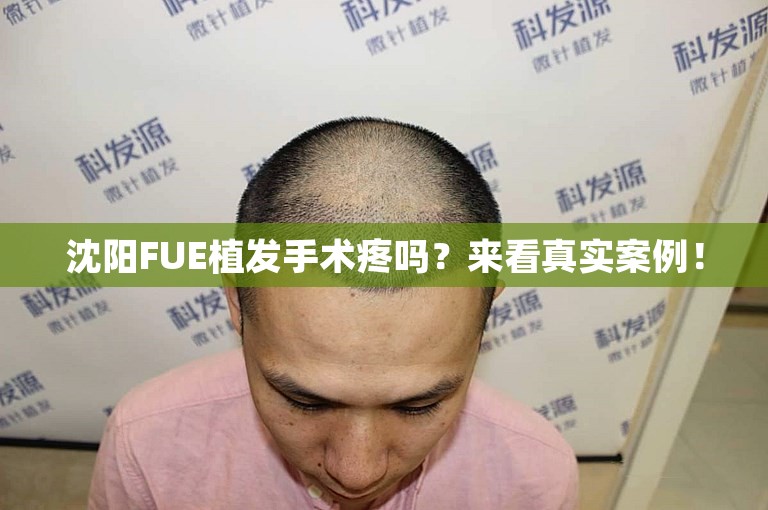 沈阳FUE植发手术疼吗？来看真实案例！