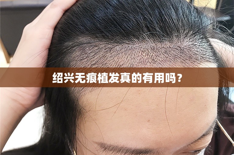 绍兴无痕植发真的有用吗？