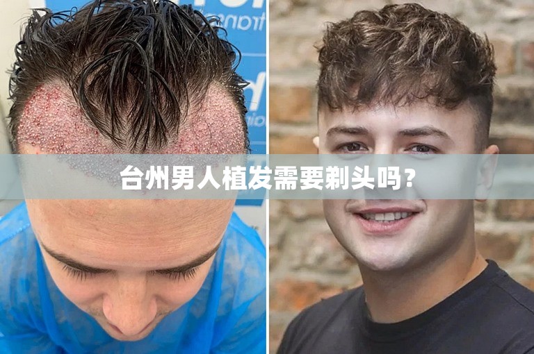 台州男人植发需要剃头吗？