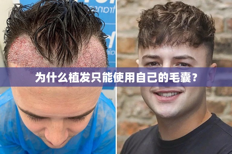 为什么植发只能使用自己的毛囊？