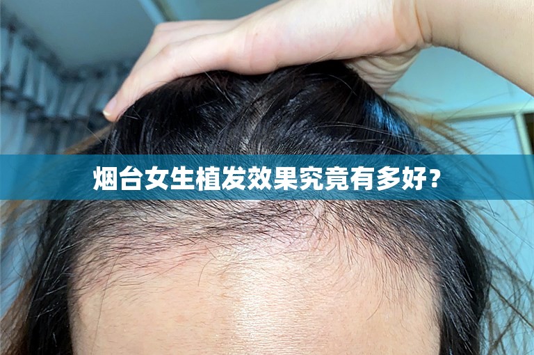 烟台女生植发效果究竟有多好？