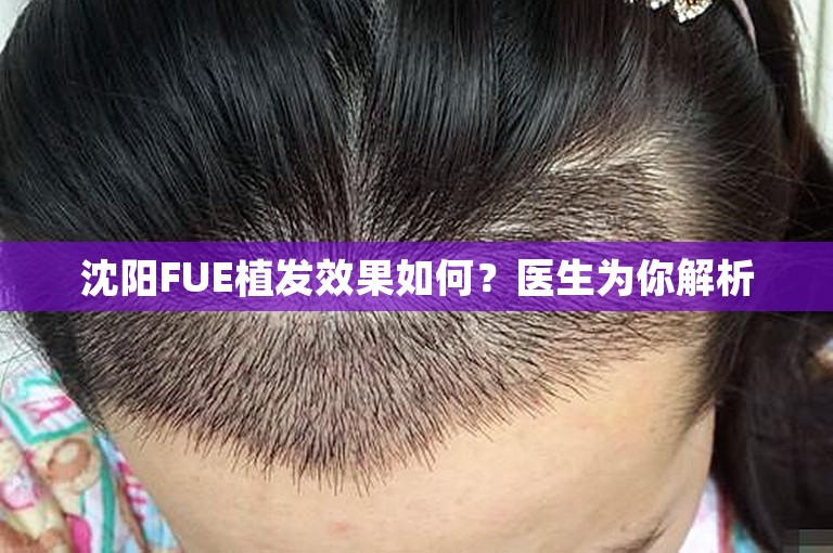 沈阳FUE植发效果如何？医生为你解析