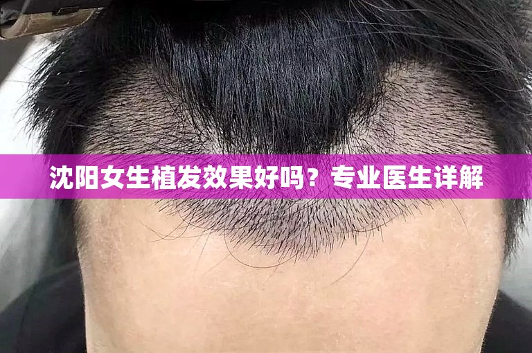 沈阳女生植发效果好吗？专业医生详解