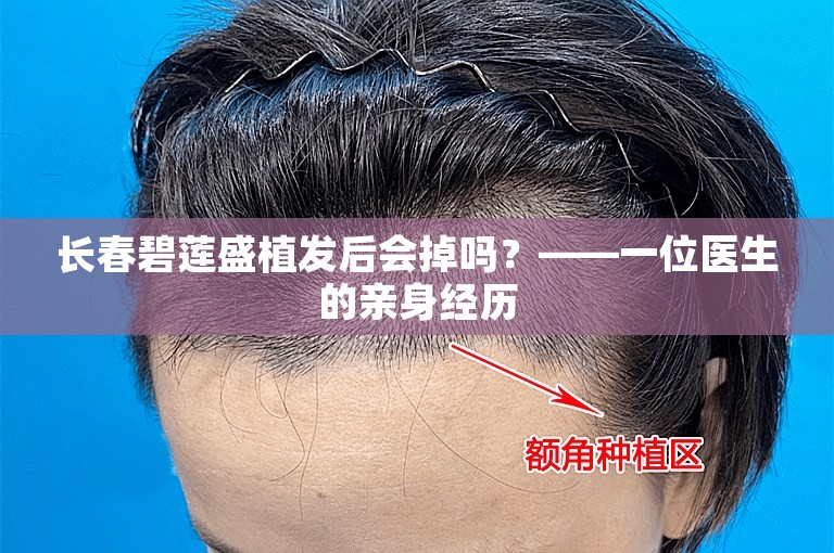 长春碧莲盛植发后会掉吗？——一位医生的亲身经历