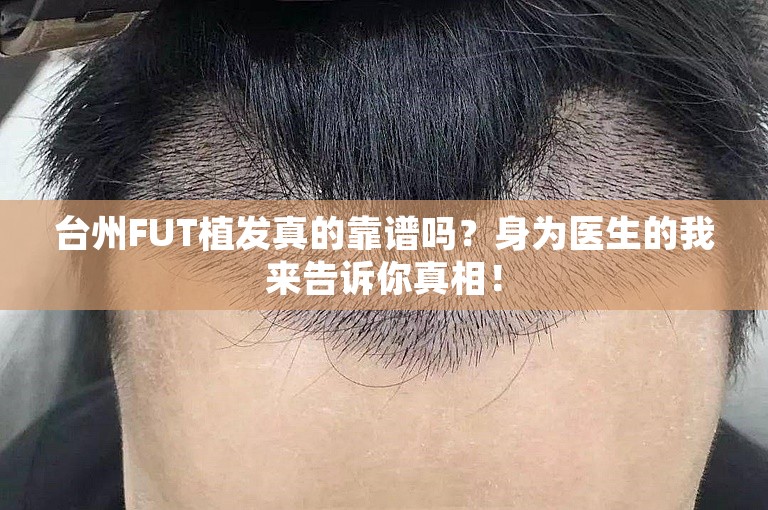 台州FUT植发真的靠谱吗？身为医生的我来告诉你真相！