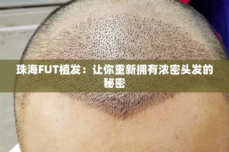 珠海FUT植发：让你重新拥有浓密头发的秘密