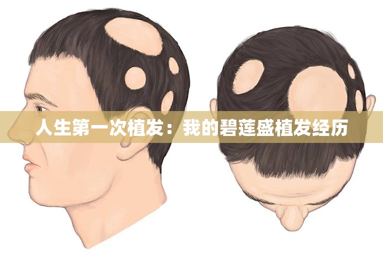 人生第一次植发：我的碧莲盛植发经历