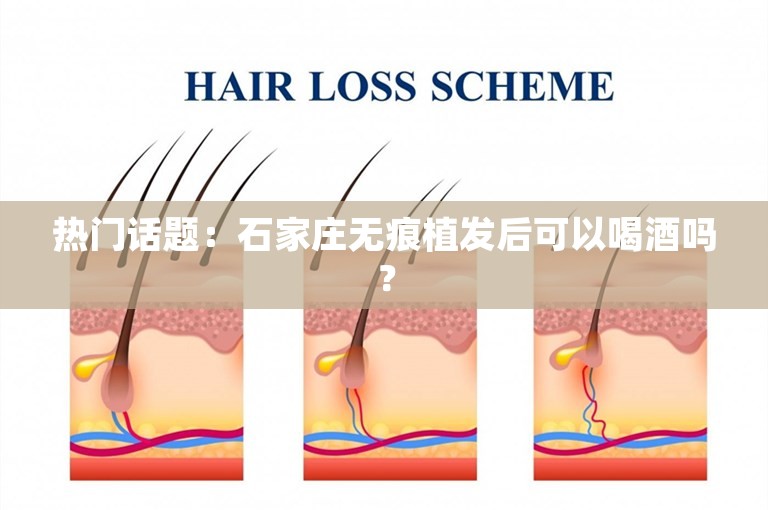 热门话题：石家庄无痕植发后可以喝酒吗？