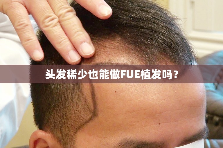 头发稀少也能做FUE植发吗？