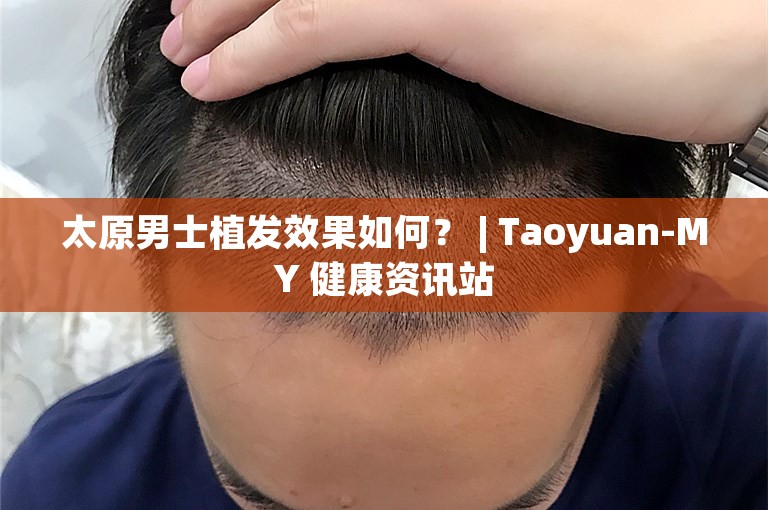 太原男士植发效果如何？ | Taoyuan-MY 健康资讯站