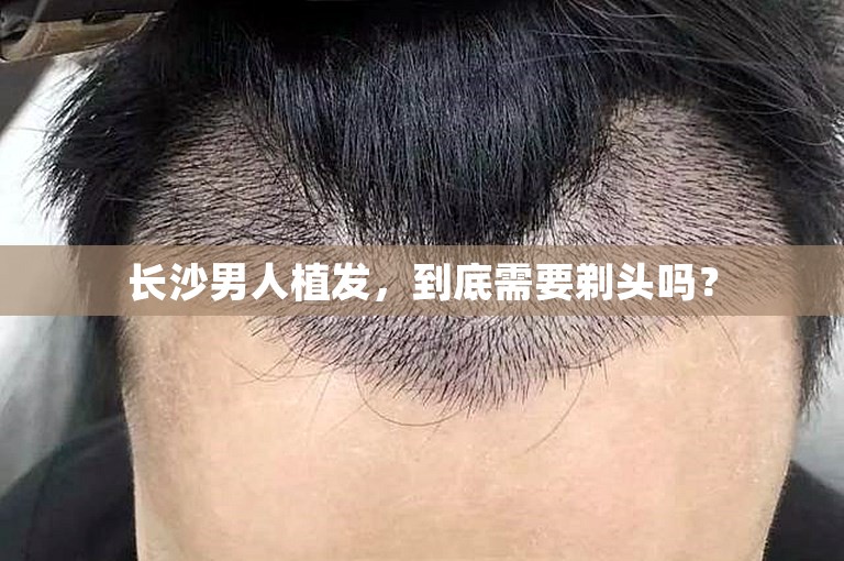 长沙男人植发，到底需要剃头吗？