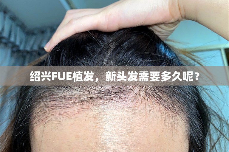 绍兴FUE植发，新头发需要多久呢？