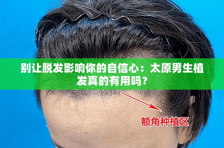 别让脱发影响你的自信心：太原男生植发真的有用吗？