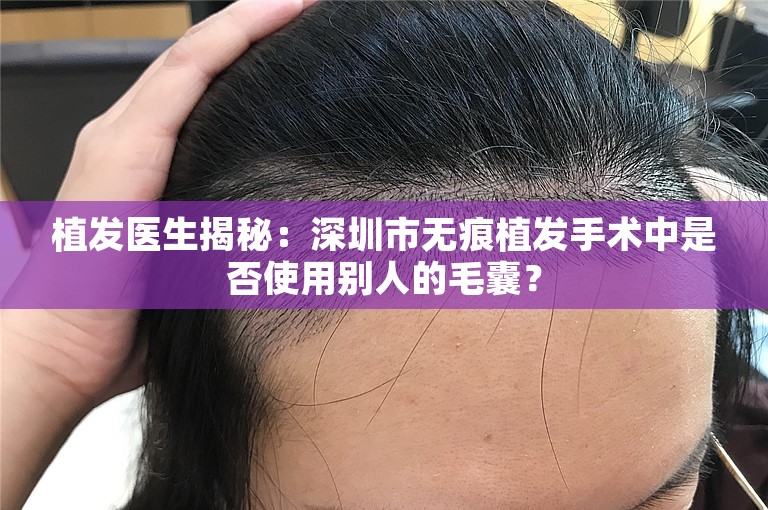 植发医生揭秘：深圳市无痕植发手术中是否使用别人的毛囊？