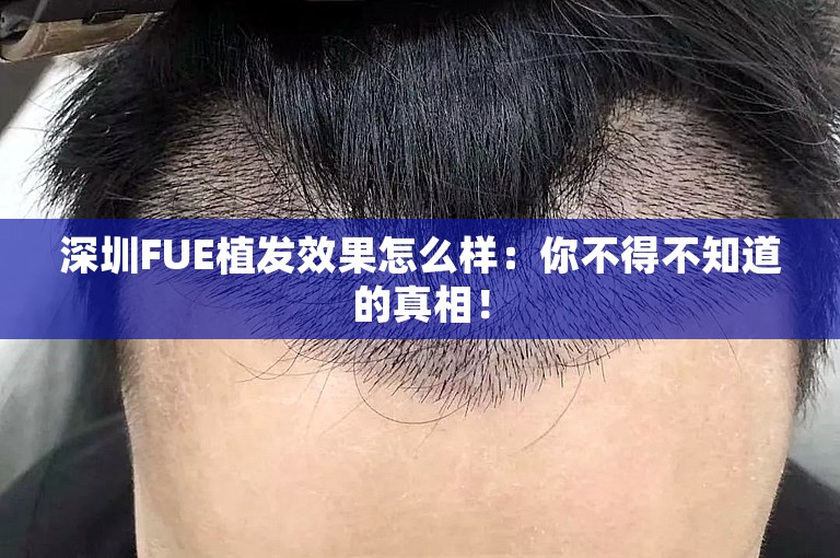 深圳FUE植发效果怎么样：你不得不知道的真相！