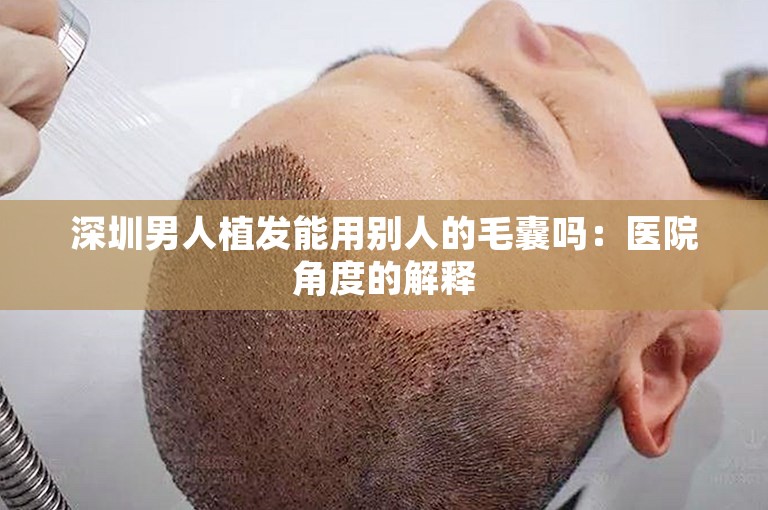 深圳男人植发能用别人的毛囊吗：医院角度的解释