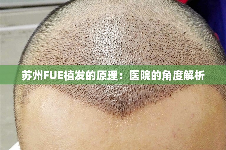 苏州FUE植发的原理：医院的角度解析