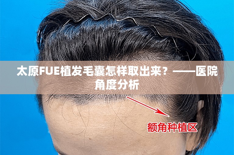 太原FUE植发毛囊怎样取出来？——医院角度分析