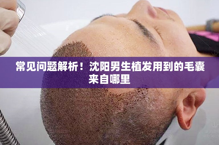 常见问题解析！沈阳男生植发用到的毛囊来自哪里