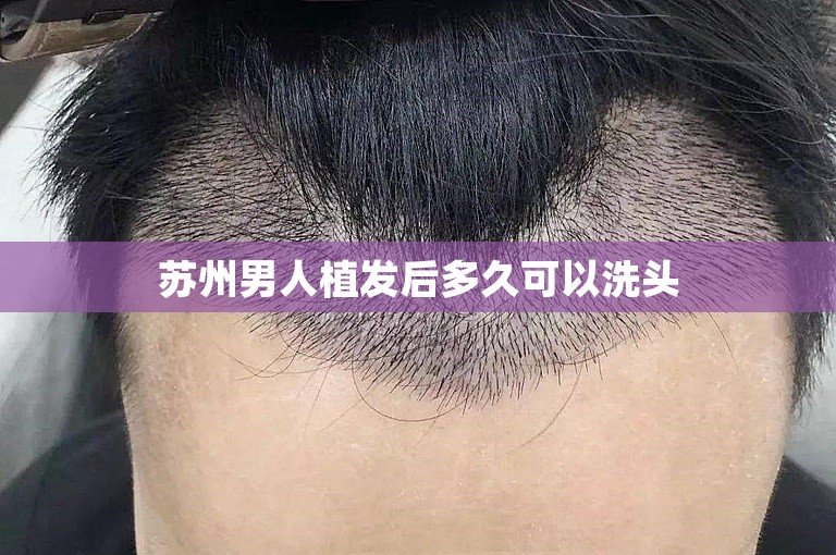 苏州男人植发后多久可以洗头