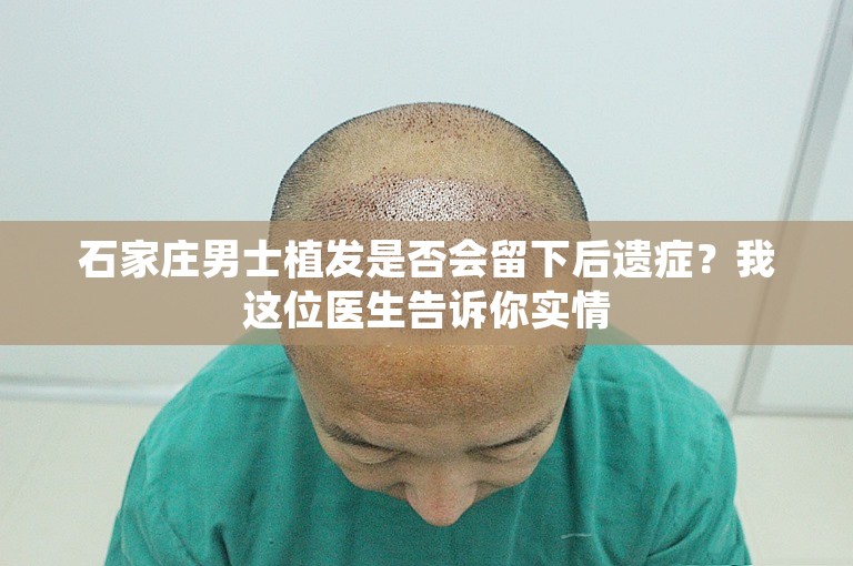 石家庄男士植发是否会留下后遗症？我这位医生告诉你实情