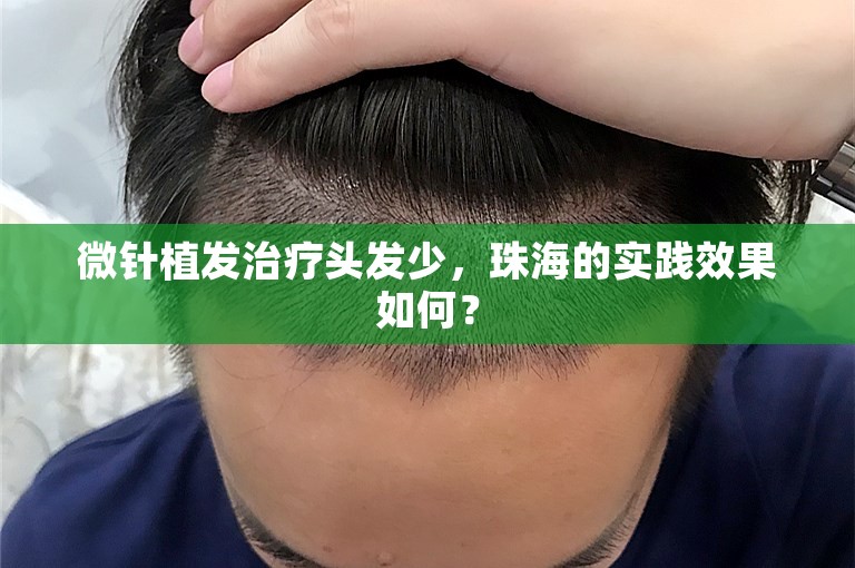 微针植发治疗头发少，珠海的实践效果如何？