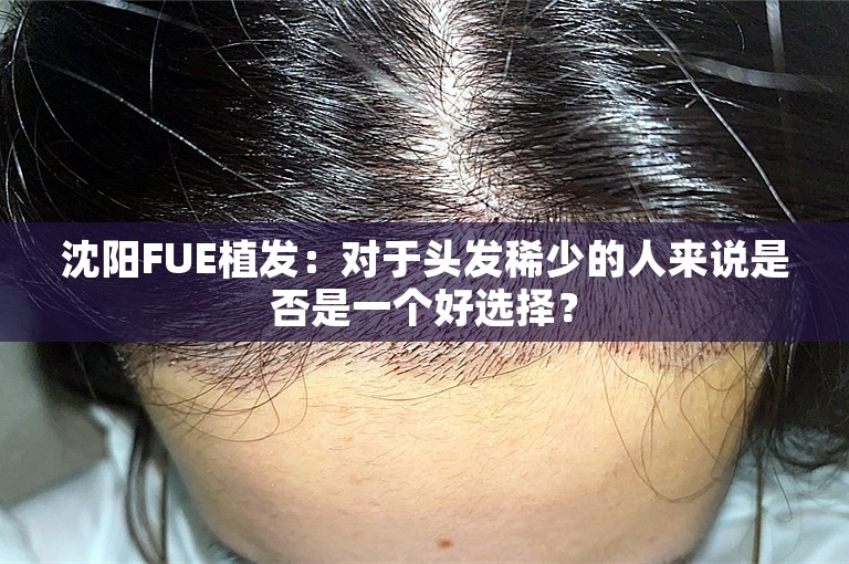 沈阳FUE植发：对于头发稀少的人来说是否是一个好选择？