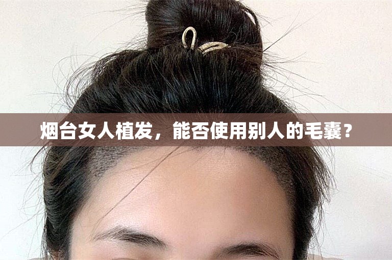 烟台女人植发，能否使用别人的毛囊？