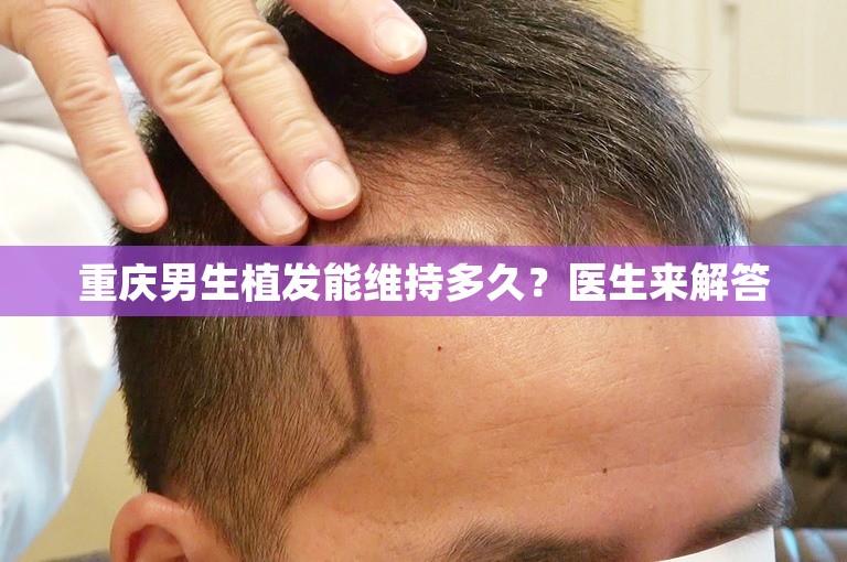 重庆男生植发能维持多久？医生来解答