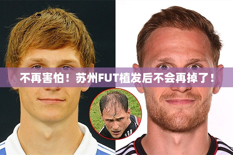 不再害怕！苏州FUT植发后不会再掉了！