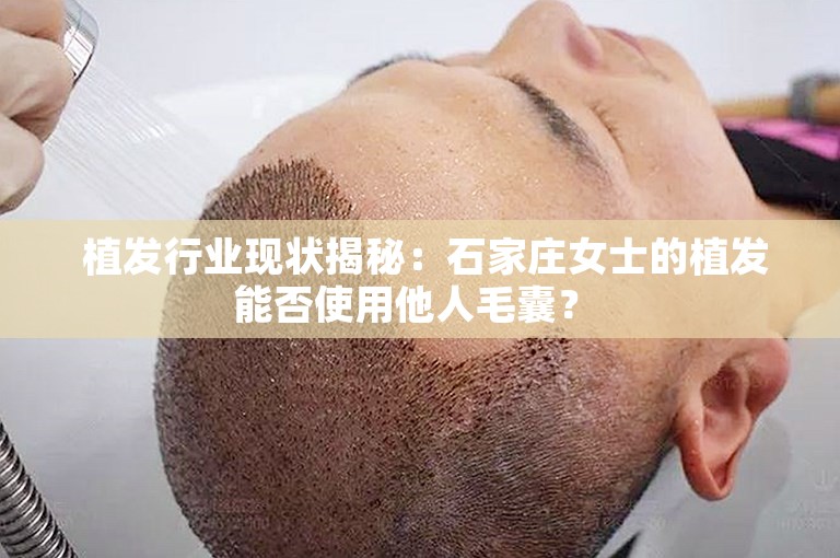  植发行业现状揭秘：石家庄女士的植发能否使用他人毛囊？ 