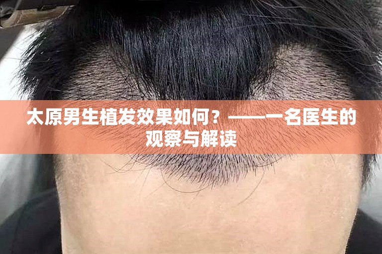 太原男生植发效果如何？——一名医生的观察与解读