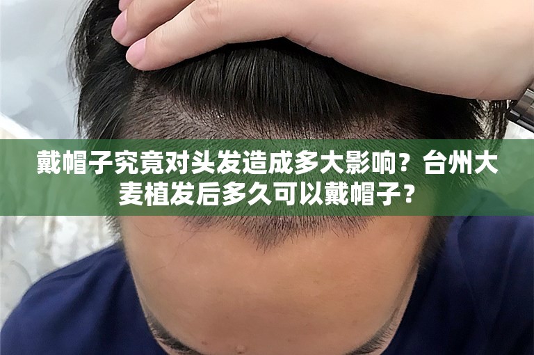 戴帽子究竟对头发造成多大影响？台州大麦植发后多久可以戴帽子？