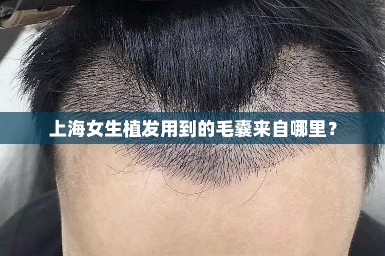 上海女生植发用到的毛囊来自哪里？