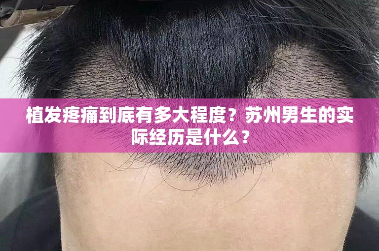 植发疼痛到底有多大程度？苏州男生的实际经历是什么？