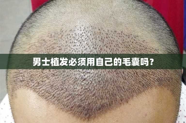 男士植发必须用自己的毛囊吗？