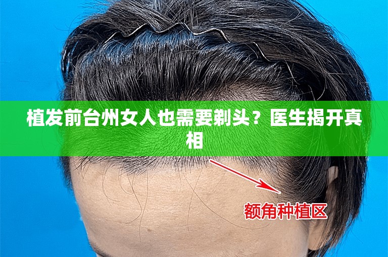 植发前台州女人也需要剃头？医生揭开真相