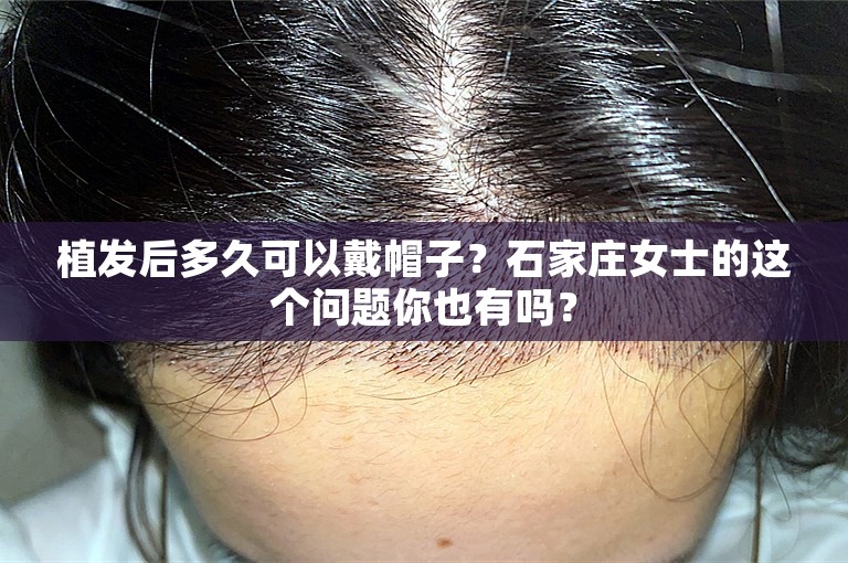 植发后多久可以戴帽子？石家庄女士的这个问题你也有吗？