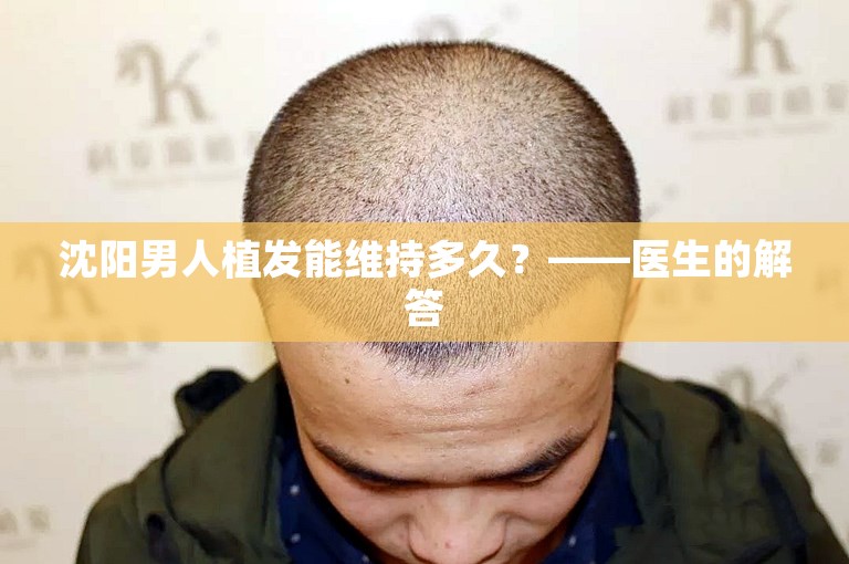 沈阳男人植发能维持多久？——医生的解答